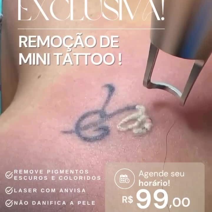 Anúncio da Pelíssima: remoção de mini tattoo por R$ 99