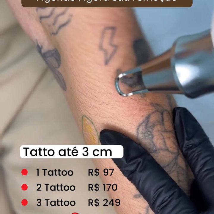 Anúncio da Pelíssima: remoção de tatuagem até 3 cm, 1 por R$ 97, 2 por R$ 170, 3 por R$ 249